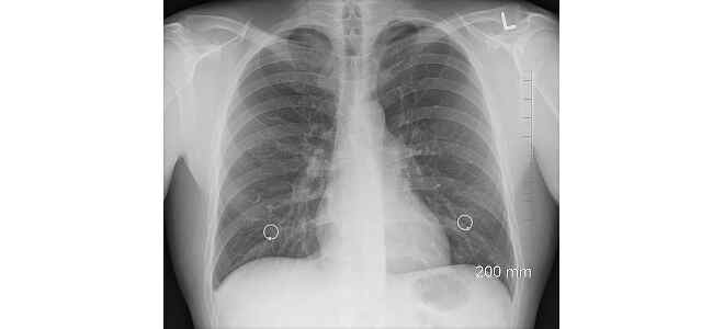  bronchial 